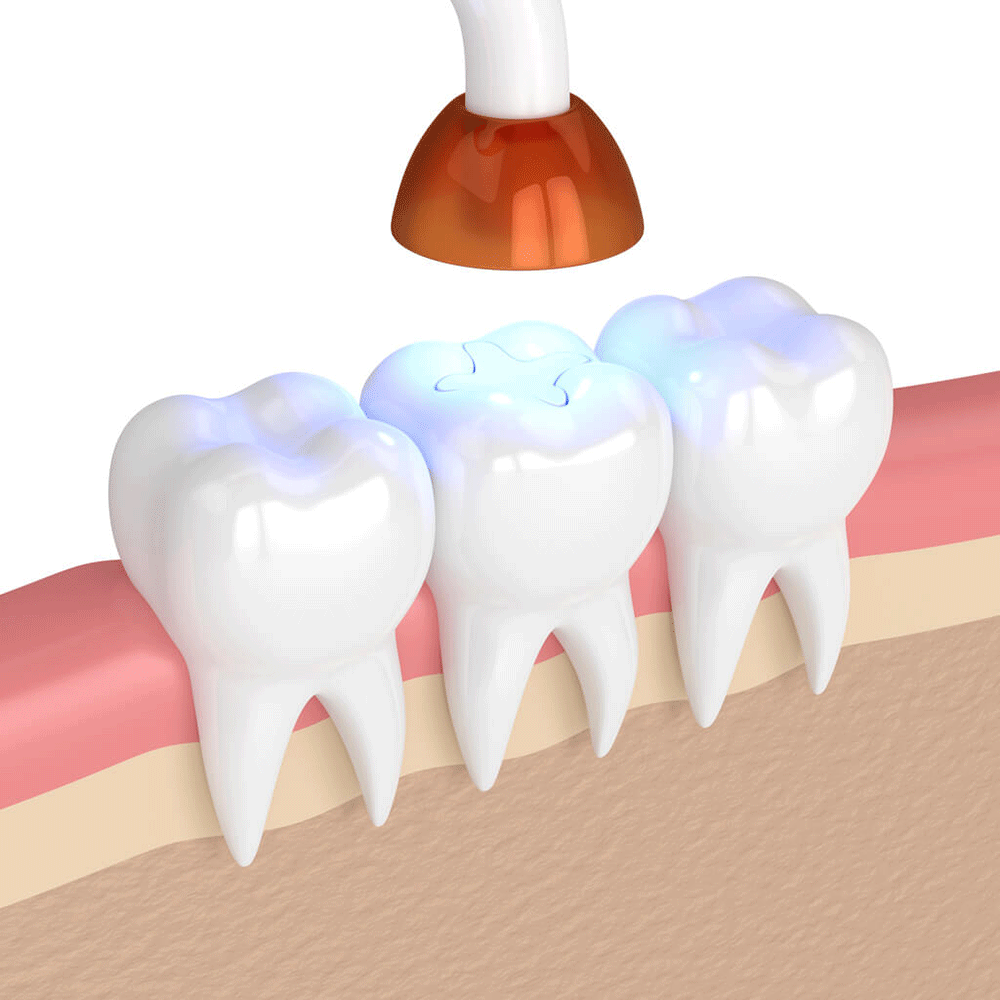 Tooth Fillings and Sealants