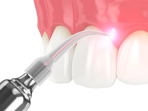 Soft tissue laser dental technology at Wellness Family Dentistry in Royal Oak, MI.
